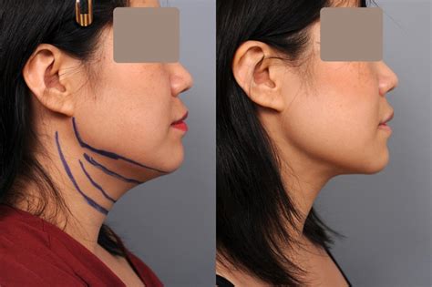 neck and chin liposuction